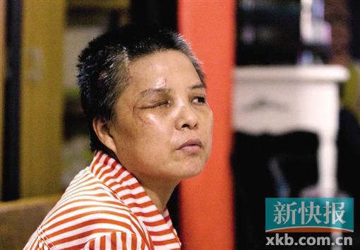 4月初,趙女士遭人搶劫并被打傷,現(xiàn)今右眼失明,頭部被縫100多針。記者 畢志毅/攝
