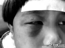 6月2日，網(wǎng)曝渭南市臨渭區(qū)一不滿5歲的女童遭奶奶毆打，眼圈青腫，引起網(wǎng)友關(guān)注，但孩子父母和爺爺均稱是摔倒導(dǎo)致。相關(guān)部門介入調(diào)查發(fā)現(xiàn)確為奶奶毆打所致，鑒于其身體原因已進(jìn)行批評(píng)教育。