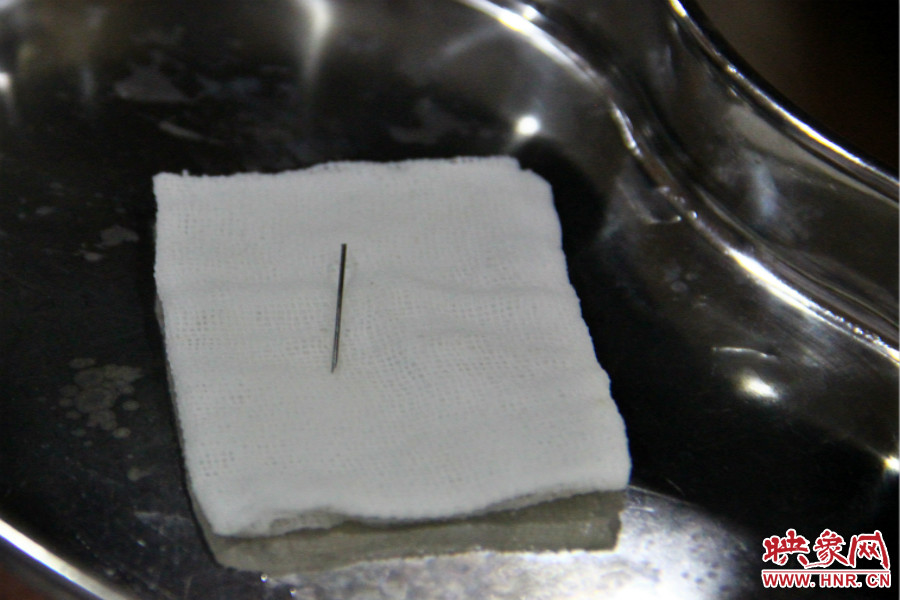 上午11點30分許，小龍腦中鋼針已經成功取出。