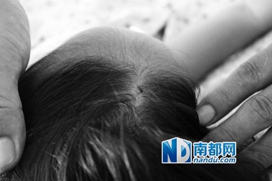 女童頭上被扎的針孔（圓圈處）。賈先生說，被扎不到三秒鐘，女兒就昏了。